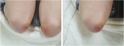 Mycophenolate mofetil after tacrolimus for refractory clinically amyopathic dermatomyositis: a case report
